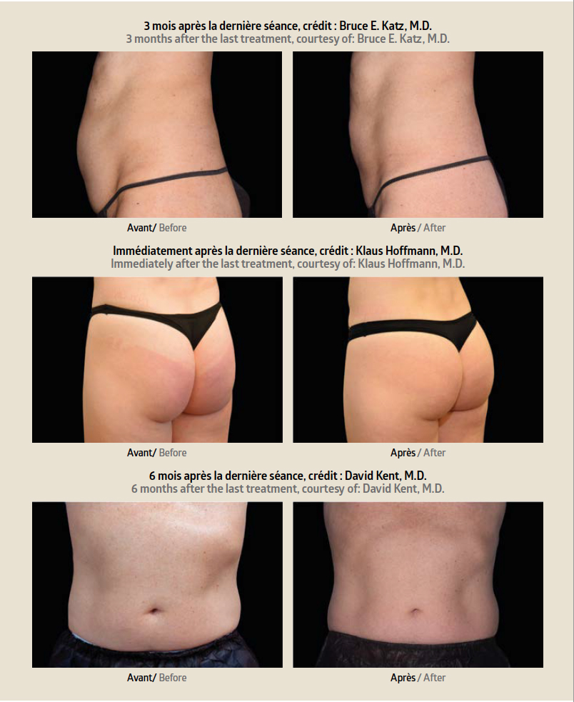 Before & After: Result of EMSculpt treatment in Paris