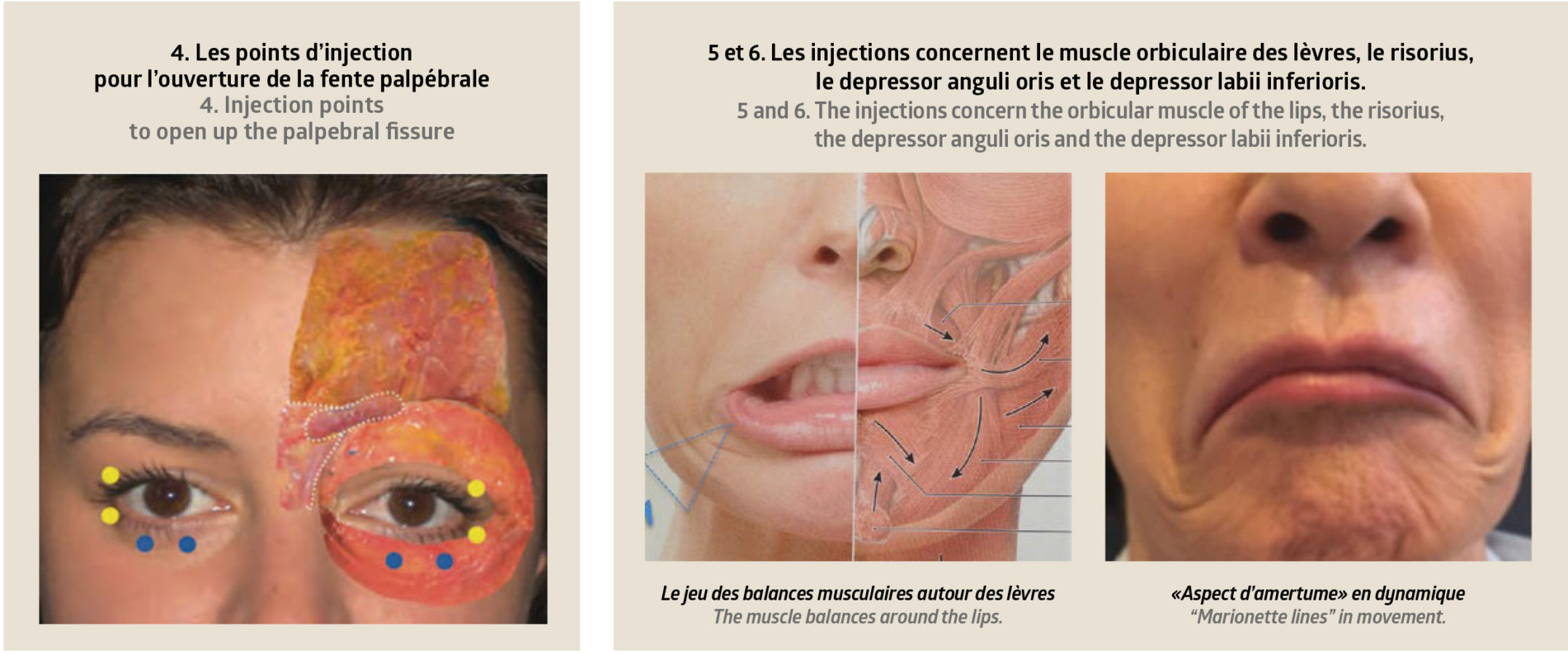 Botulinum toxin and balancing the facial muscles – Anti Age and ...