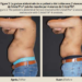 Paradigm in the treatment approach to body contouring: CRISTAL BODY-LAYERING®