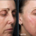 A new therapeutic approach to treat aging of the face during menopause